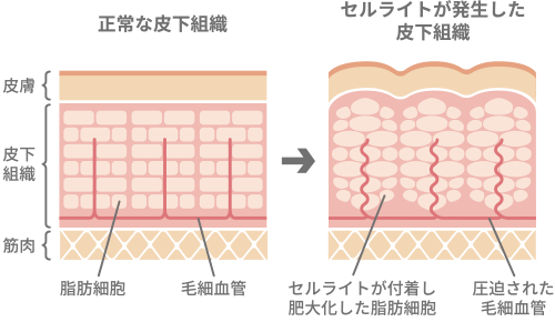 セルライトとは…