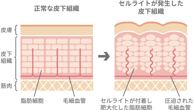 セルライトとは…